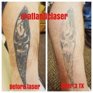 rimozione-laser-tattoo-dopo-3-sessioni-photocredit-@atlanticlaser
