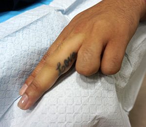Rimozione-tatuaggio-chirurgia-prima-photocredit-@misbahkhanmd.com_
