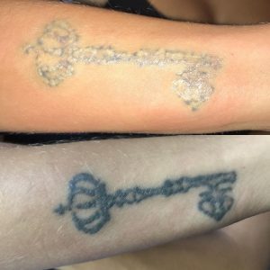 rimozione-tattoo-popcorn-effect-photocredit-@beautiful_skin_lasertherapie
